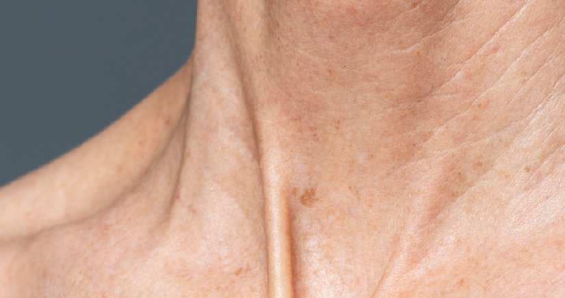 melasma treatment near me